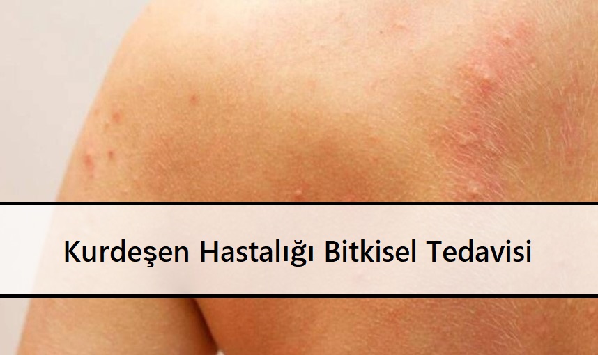 Kurdeşen Hastalığı Bitkisel Tedavisi