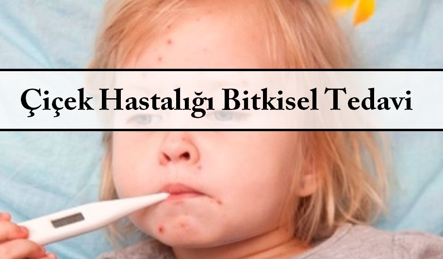 Çiçek Hastalığı Bitkisel Tedavi