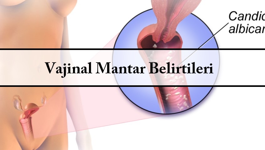 Vajinal Mantar Belirtileri