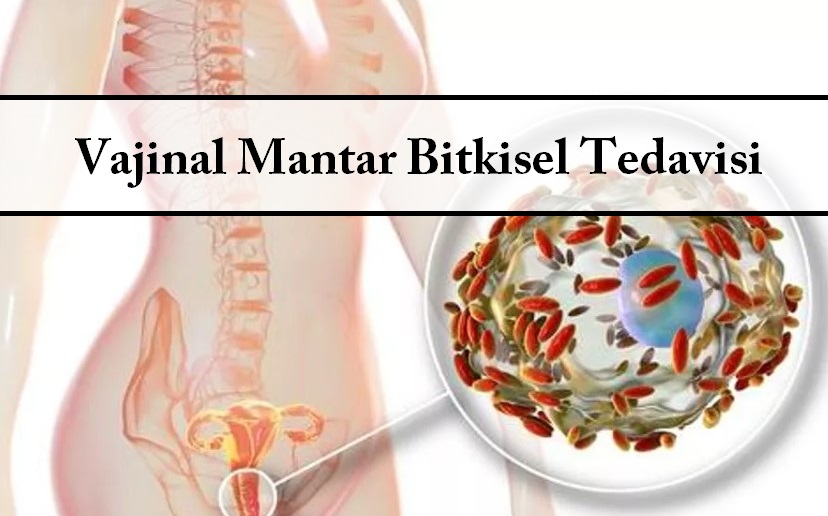 Vajinal Mantar Bitkisel Tedavisi