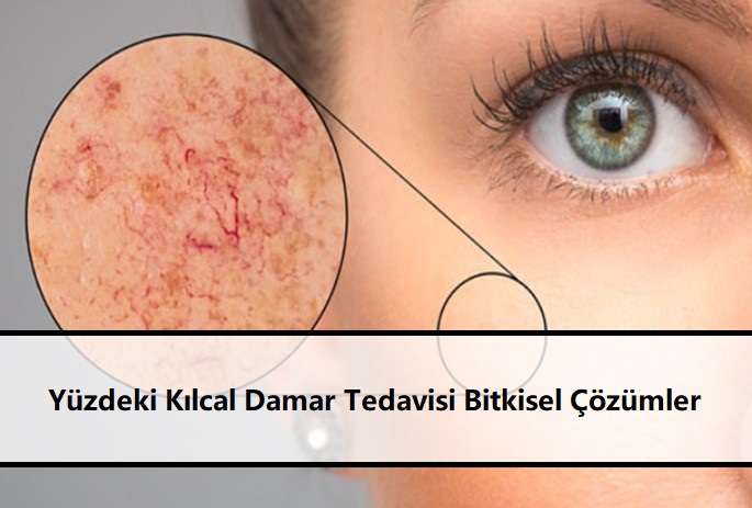 Yüzdeki Kılcal Damar Tedavisi Bitkisel Çözümler