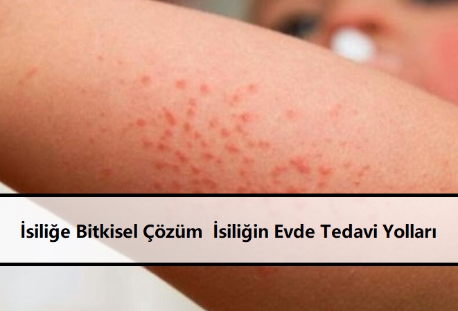 İsiliğe Bitkisel Çözüm İsiliğin Evde Tedavi Yolları