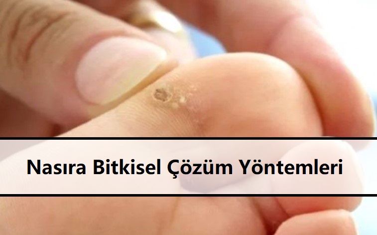 Nasıra Bitkisel Çözüm Yöntemleri