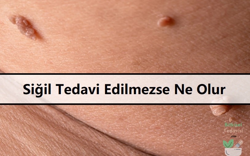 Siğil Tedavi Edilmezse Ne Olur