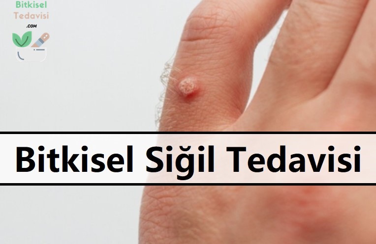 Bitkisel Siğil Tedavisi