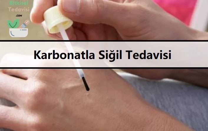 Karbonatla Siğil Tedavisi