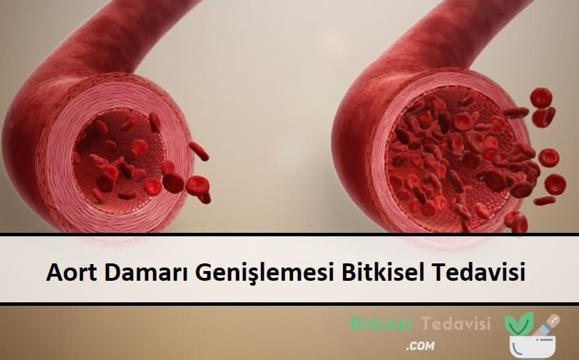 Aort Damarı Genişlemesi Bitkisel Tedavisi