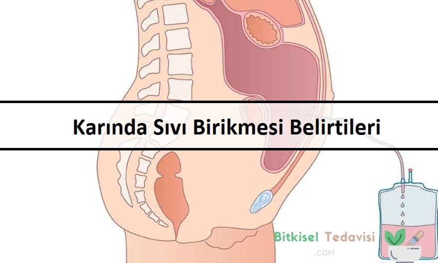 Karında Sıvı Birikmesi Belirtileri