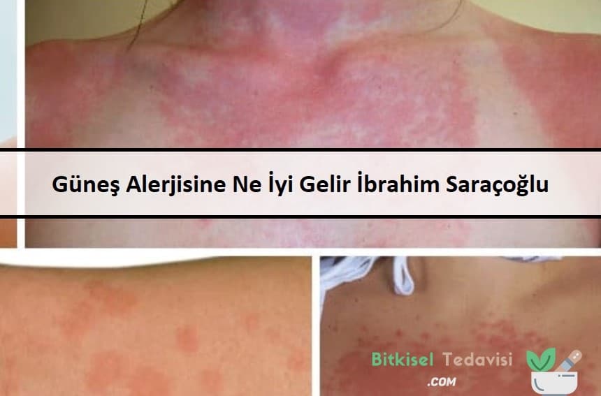 Güneş Alerjisine Ne İyi Gelir İbrahim Saraçoğlu