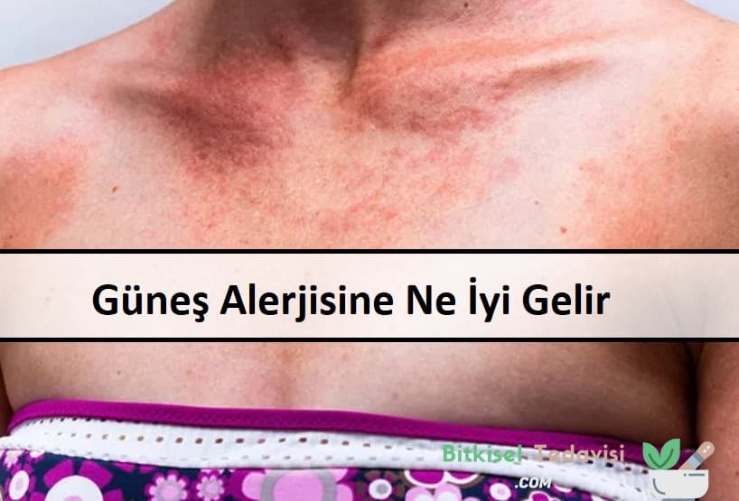 Güneş Alerjisine Ne İyi Gelir