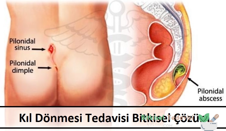 Kıl Dönmesi Tedavisi Bitkisel