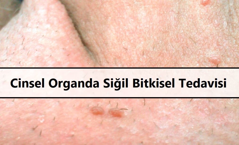 Cinsel Organda Siğil Bitkisel Tedavisi