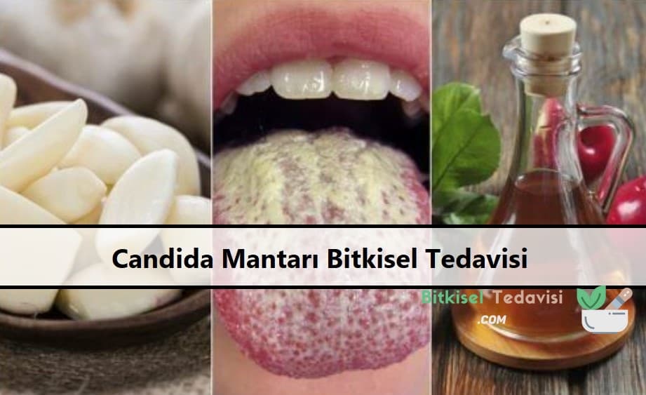 Candida Mantarı Bitkisel Tedavisi