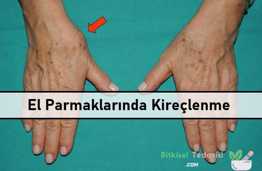 El Parmaklarında Kireçlenme Bitkisel Tedavisi