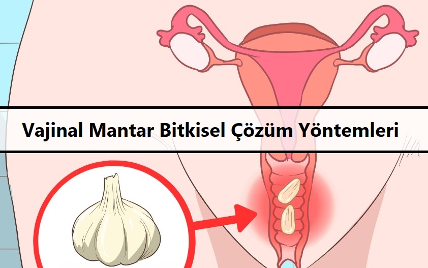 Vajinal Mantar Bitkisel Çözüm Yöntemleri