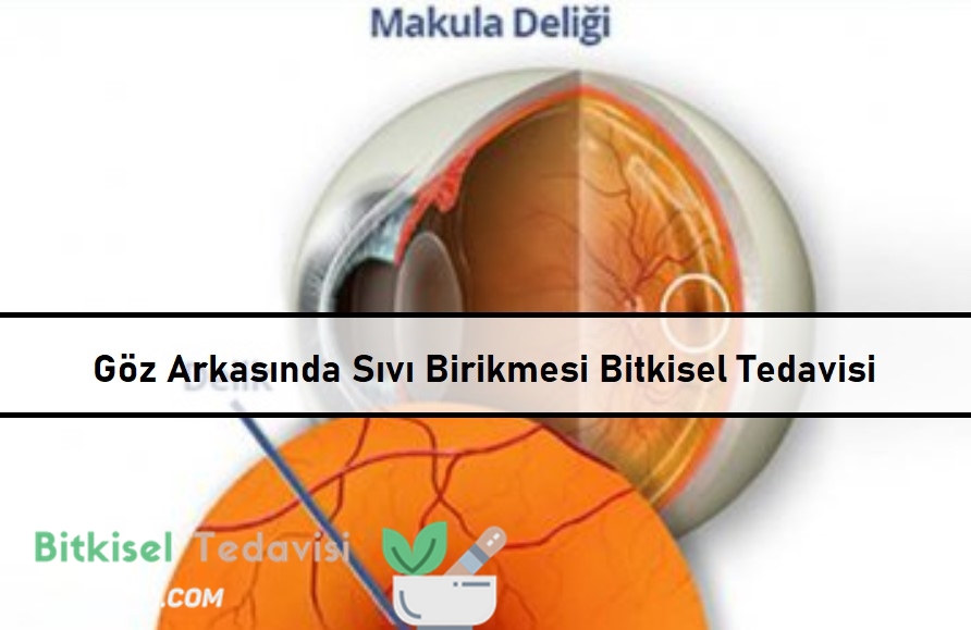 Göz Arkasında Sıvı Birikmesi Bitkisel Tedavisi