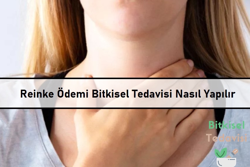 Reinke Ödemi Bitkisel Tedavisi Nasıl Yapılır