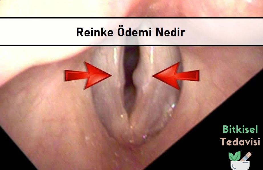 Reinke Ödemi Nedir